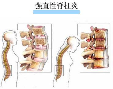 强直性脊柱炎患者的职场困境，现实挑战与健康权益的反思