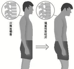 部队新规下强直性脊柱炎的管理策略及应对策略