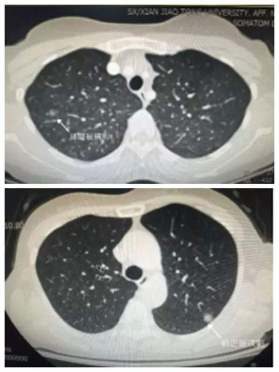 女子肺部磨玻璃结节癌变理赔遭拒，健康保险的挑战与应对策略