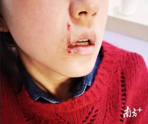 女子误食摔炮口腔受伤事件，警醒与反思